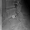 disc replacement ball xray