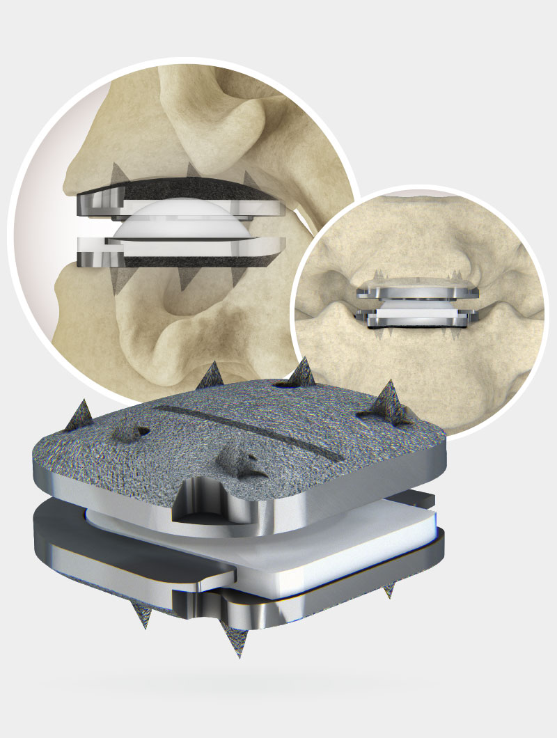 prodisc c vivo disc replacement