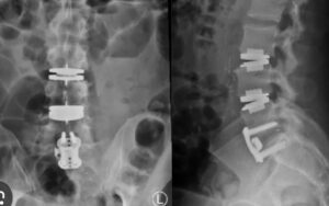 hybrid disc replacement fusion surgery xray hybrid disc replacement fusion surgery xray